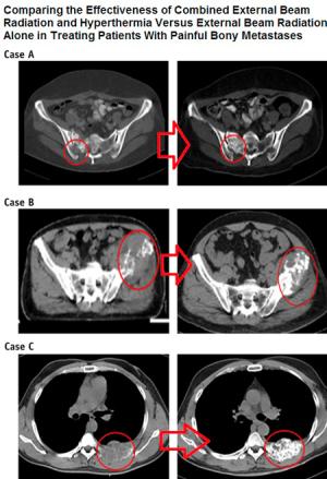 Ağrılı Kemik Metastazında Radyoterapiye Derin Doku RF Hipertermi Eklenmesi Tedavinin Başarısını Arttırıyor
