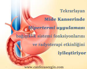 Tekrarlayan Mide Kanserinde Hipertermi Uygulaması Bağışıklık Sistemi Fonksiyonlarını ve Radyoterapi Etkinliğini İyileştiriyor
