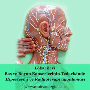 Lokal İleri Baş ve Boyun Kanserlerinin Tedavisinde Hipertermi ve Radyoterapi Uygulaması