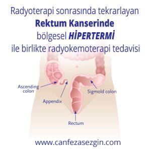 Radyoterapi Sonrasında Tekrarlayan Rektum Kanserinde Bölgesel Hipertemi ile Birlikte Radyokemoterapi Tedavisi