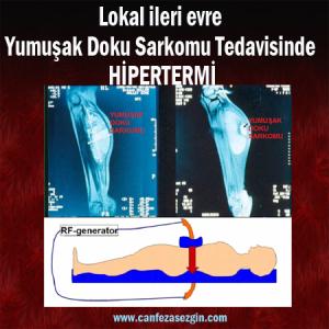 Lokal İleri Evre Yumuşak Doku Sarkomu Tedavisinde Hipertermi ve Sistemik Tedavi