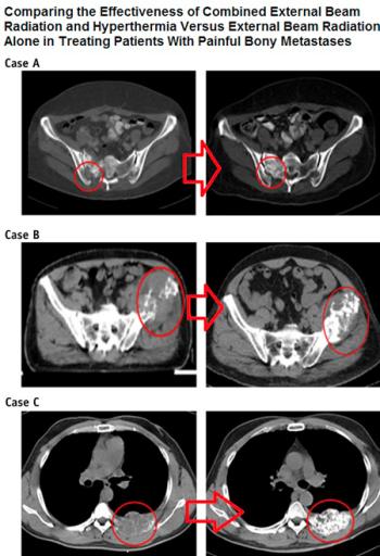 Ağrılı Kemik Metastazında Radyoterapiye Derin Doku RF Hipertermi Eklenmesi Tedavinin Başarısını Arttırıyor