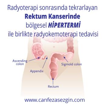 Radyoterapi Sonrasında Tekrarlayan Rektum Kanserinde Bölgesel Hipertemi ile Birlikte Radyokemoterapi Tedavisi