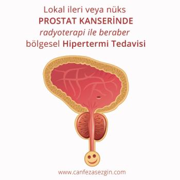 Lokal İleri veya Nüks Prostat Kanserinde Radyoterapi ile Beraber Bölgesel Hipertermi Tedavisi