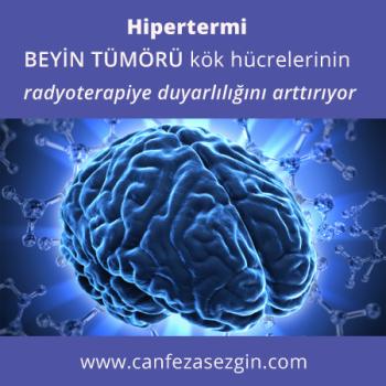 Hipertermi Beyin Tümörü Kök Hücrelerinin Radyoterapiye Duyarlılığını Arttırıyor