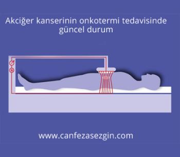 Akciğer Kanserinin Onkotermi Tedavisinde Güncel Durum