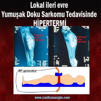 Lokal İleri Evre Yumuşak Doku Sarkomu Tedavisinde Hipertermi ve Sistemik Tedavi