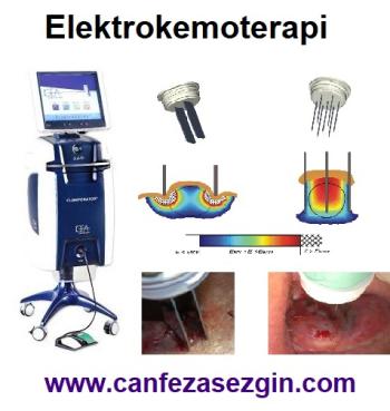 Elektrokemoterapi: Kanserde Yan Etkisi Az Tedavi