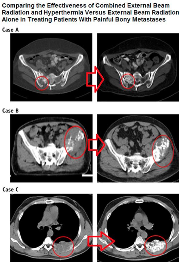 Ağrılı Kemik Metastazında Radyoterapiye Derin Doku RF Hipertermi Eklenmesi Tedavinin Başarısını Arttırıyor