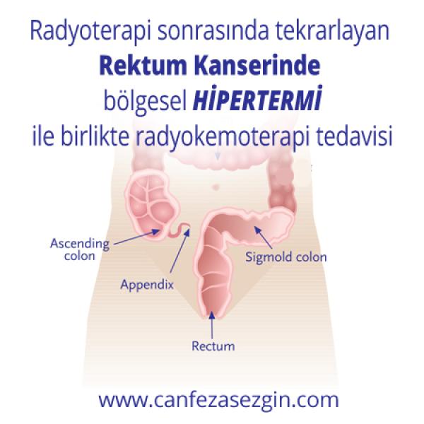 Radyoterapi Sonrasında Tekrarlayan Rektum Kanserinde Bölgesel Hipertemi ile Birlikte Radyokemoterapi Tedavisi
