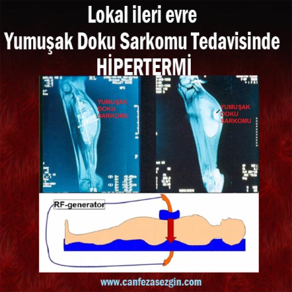 Lokal İleri Evre Yumuşak Doku Sarkomu Tedavisinde Hipertermi ve Sistemik Tedavi